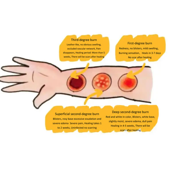 Clinical Solutions for Burns